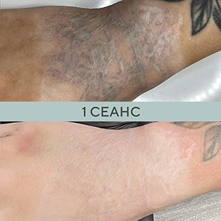 Фото до и после сведение татуировок лазером
